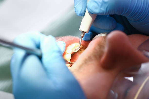 Best Broken or Chipped Tooth Repair in Maple Valley, WA